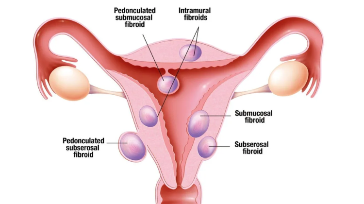 What is fibroid